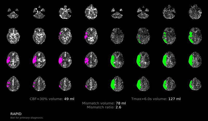 Imaging with RapidAI