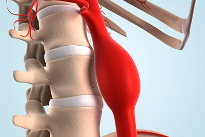 Aortic aneurysm